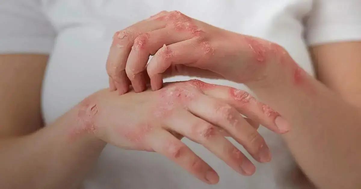 Desafios do Lúpus no Brasil: Falta de Mapeamento Prejudica Diagnóstico