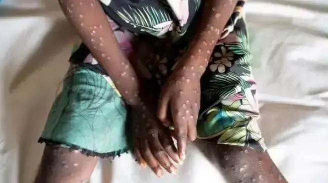 Presidente Prudente registra mais dois casos de mpox; total chegará a nove em 2023