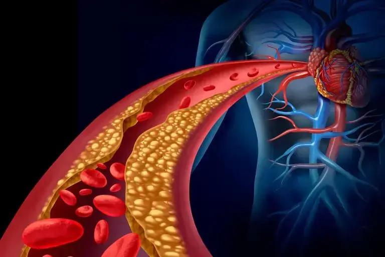 Colesterol em Nível Crítico: Entenda os Riscos e Cuidados Necessários